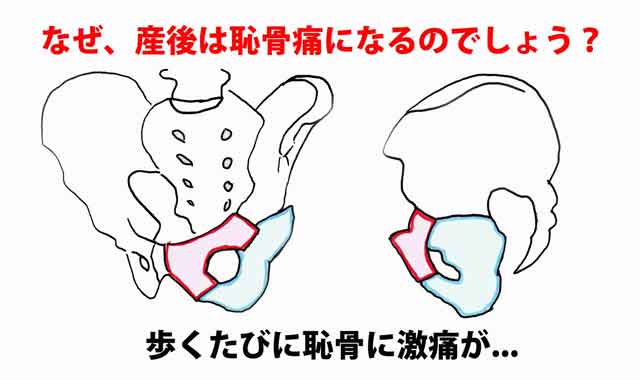 急 に 恥骨 が 痛い