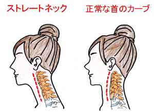 ストレートネックと正常な首の比較