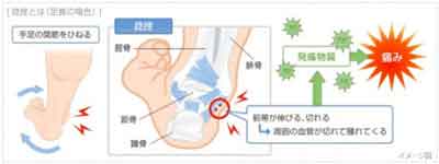 足首の捻挫