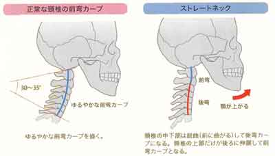 ストレートネック