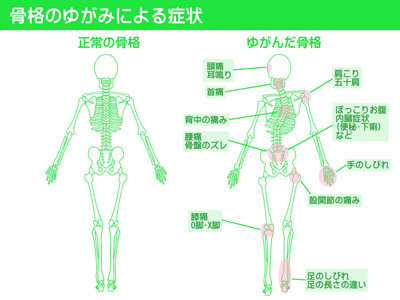 骨格の歪みによる症状